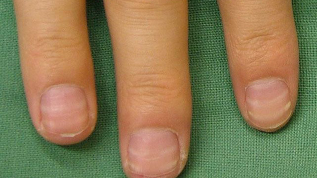 What Causes White Stripes In Fingernails