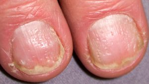 You Should Never Ignore These 9 Things Your Fingernails Reveal About ...