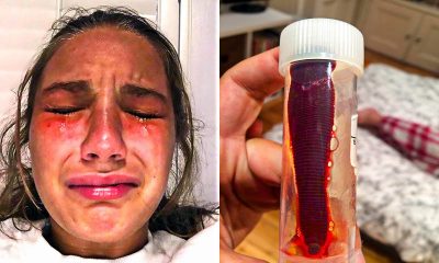 Girl Has Intense Itch Inside Nose - Visits Doctors And Makes Horrifying Discovery