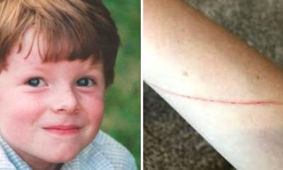 Child Got A Small Cut On His Arm And Doctors Told Him It's Nothing, But Then The Horror Raised