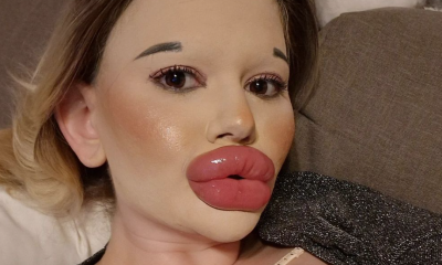 24-Year-Old Bulgarian Woman Does 27 Procedures To Have The Biggest Lips In The World