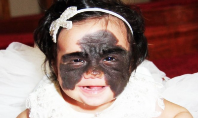 Girl With A ‘Batman Birthmark' Finally Got It Removed With Groundbreaking Surgery. Wait Till You See How She Looks Now