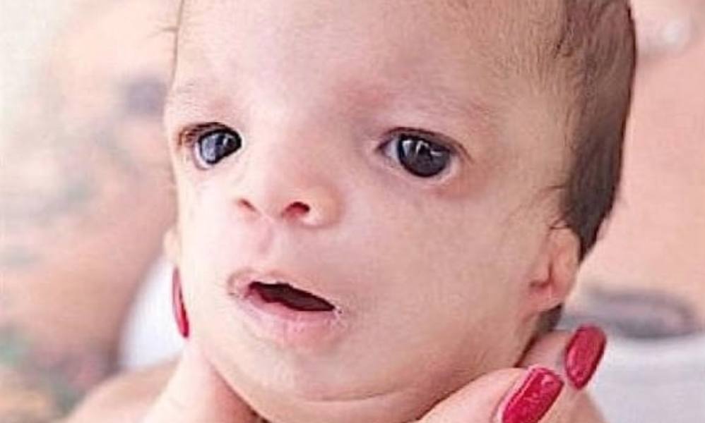 Woman Gives Birth To A Baby Daughter With Rare Condition And Is Puzzled ...