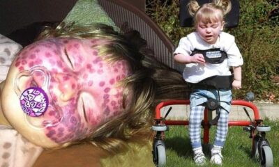 Here Is Matilda Callaghan’s Story, The Girl Covered In Polka Dots
