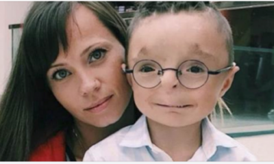 Woman Adopts A Boy No One Wanted To Adopt: See What He Looks Like Now