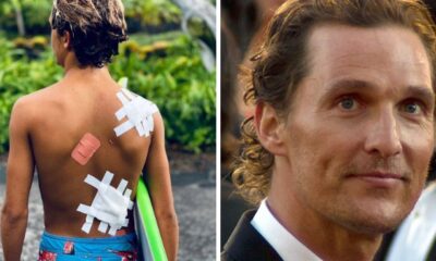 Matthew McConaughey Displays His Son’s Serious Surf Injuries As “Souvenirs”