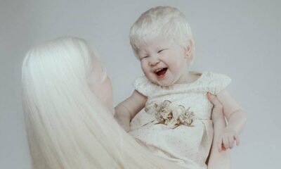 Albino Sisters Born 12 Years Apart Become Worldwide Sensations