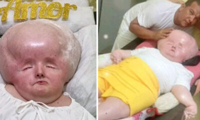 Girl Born With Gigantic Head That Refuses To Stop Growing Stuns Doctors Decades Later