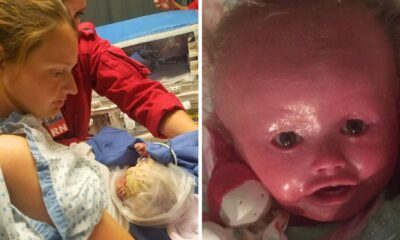 A Baby Girl Who 'Never Stops Smiling' Is Living With A Rare Skin Condition That Makes Her Skin Crack