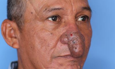 Ny Man With Severe Deformity Gets New Nose For Christmas