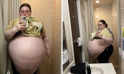 Woman's Belly Size Became Gigantic—Doctors Were Shocked When They Saw What Came Out