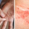 If You Notice Painful Red Bumps, You Might Have Dyshidrotic Eczema