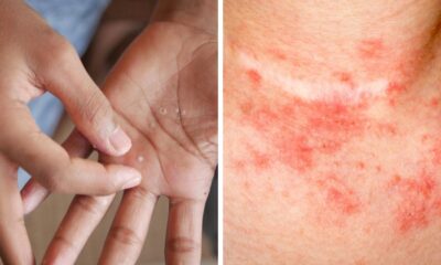 If You Notice Painful Red Bumps, You Might Have Dyshidrotic Eczema