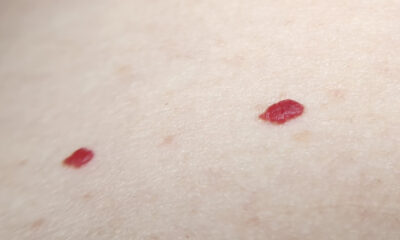 If You Spot These Red Dots On Your Skin, You Had Better Know What They Mean