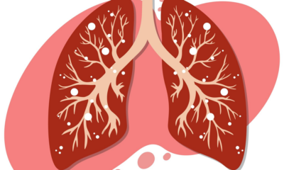 A Tiny Tree Was Discovered Growing Within A Man's Lung