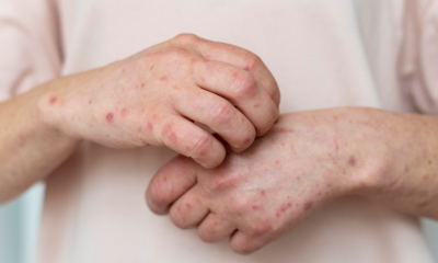 Queensland On High Alert After Potential Measles Outbreak Linked To Recent Traveller