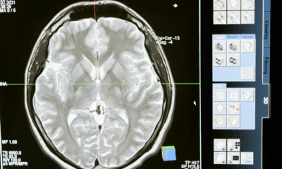 Doctors Warn: These Aneurysm Symptoms Could Be