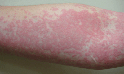 Surprising Causes Of Hives Revealed