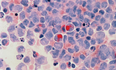 Scientists Reveal Simple Blood Test Can Detect Cancer