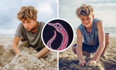 Florida Teen Develops Painful Hookworm Infection After Sand Burial