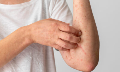 Understanding And Preventing Skin Irritation
